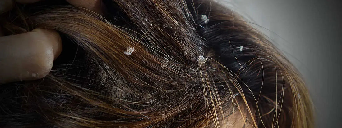 Does Keratin Treatment Help or Worsen Dandruff?
