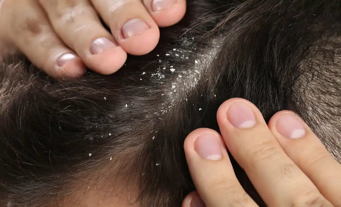 Why Dandruff Happens After a Keratin Treatment